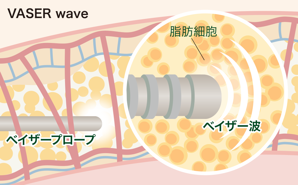 ベイザー脂肪吸引